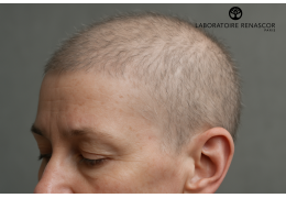Les 10 erreurs qui retardent la repousse capillaire post-oncologique